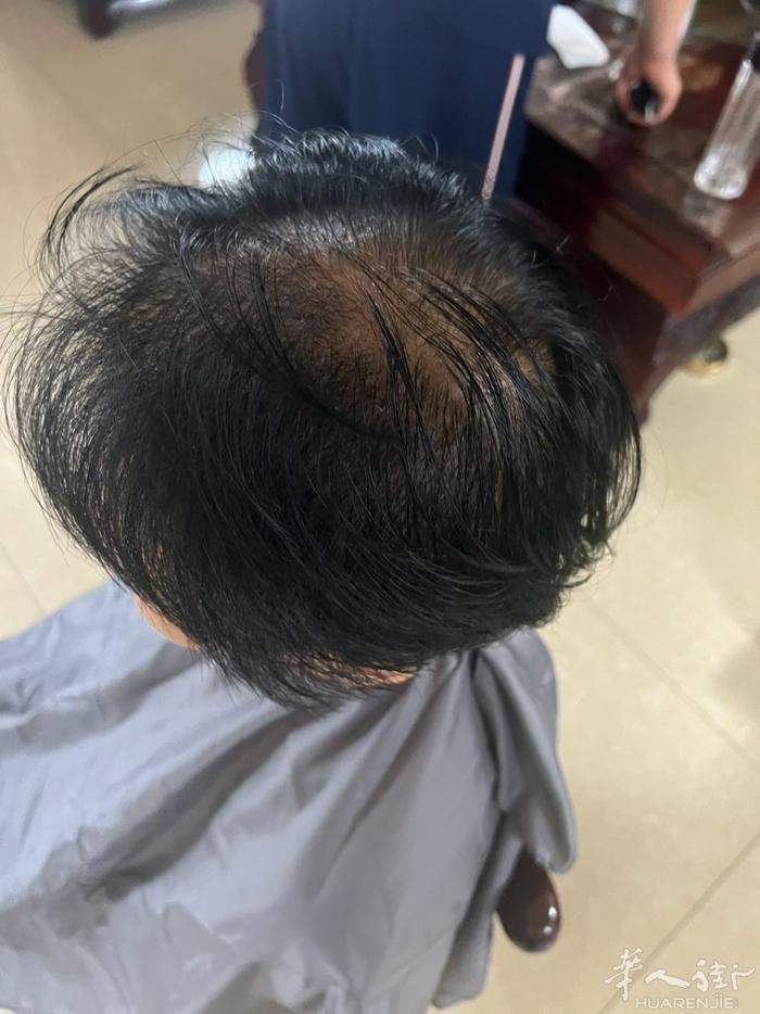 脱发者的福音  春天来了，万物复苏，也是少发者最佳调理长头的时间，如果你对你的头