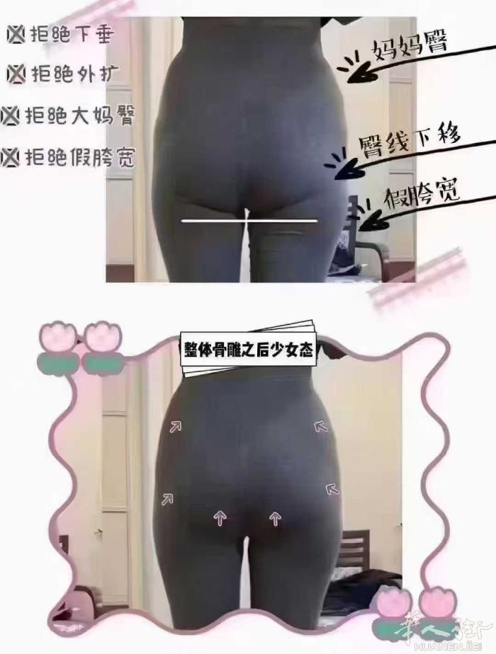 怎么理解盆腔闭合术 通俗的说：就是把怀孕10个月被撑开的骨盆、腹直肌、盆底肌都归