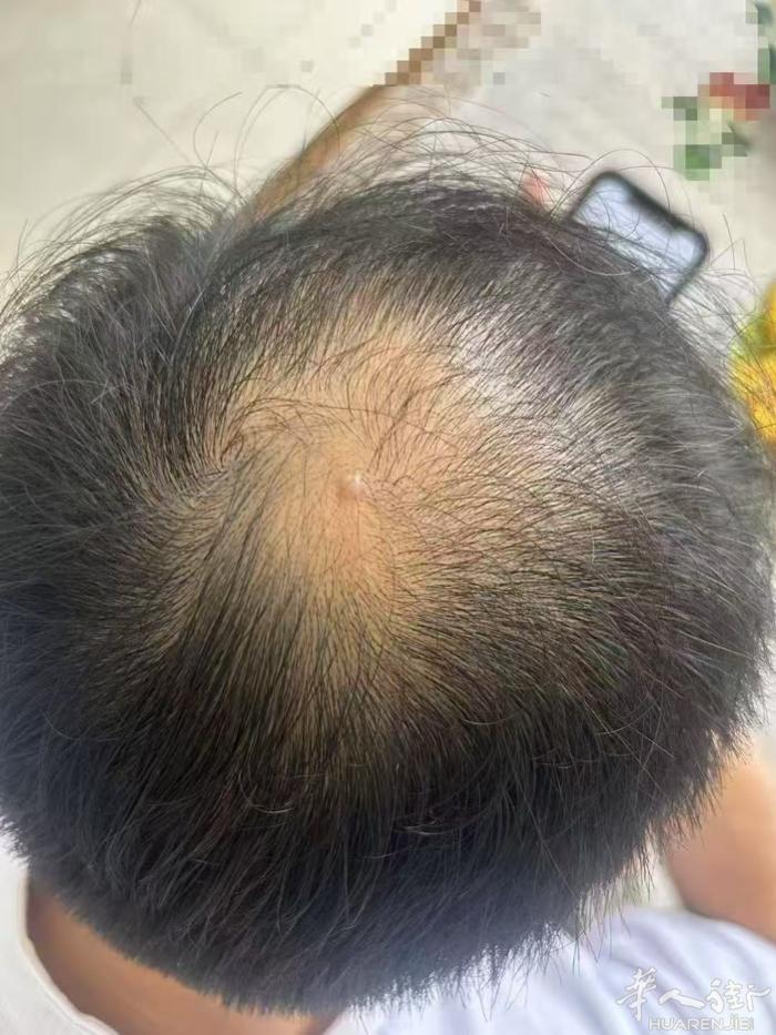 长发最佳时期 生发是春节最好的黄金时期， 而火刀灸疗法正是给头皮疏通（土地需要除
