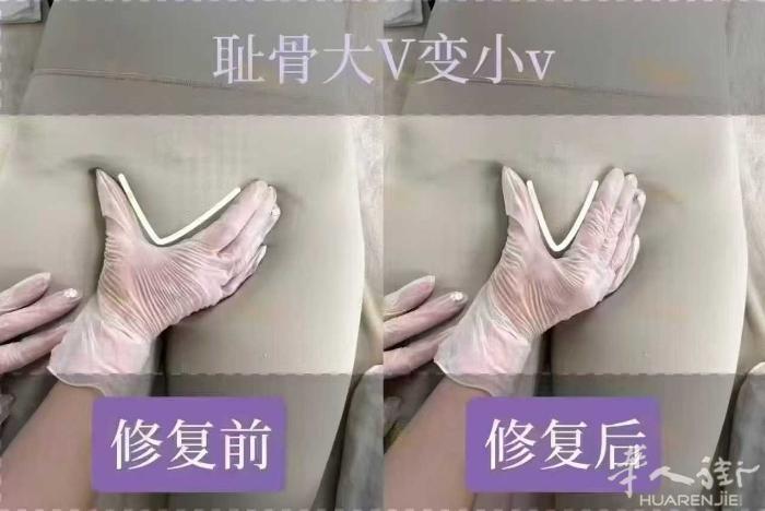 为什么要做耻骨闭合？你一定要知道！✨  😎做耻骨闭合就像给身体一个修复的机会。