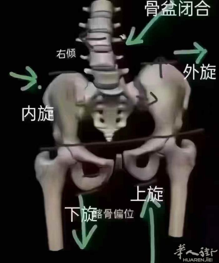 [爱心]漏尿～腰疼～胯大[跳跳][跳跳] 真没考虑是骨盆的问题吗? 你和朋友走路