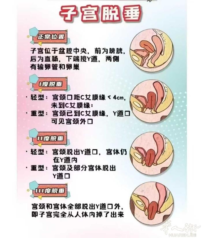 [爱心]子宫脱垂——“掉”下来的难言之隐 一张图让你看明白子宫脱垂的轻重情况！