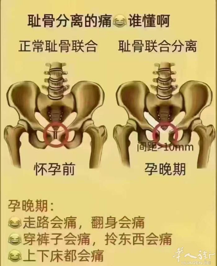 ❣👉🏻骨盆不闭合，不修复会怎么样？ 1．漏风﹣宫寒 2．漏尿﹣盆底肌松弛 3