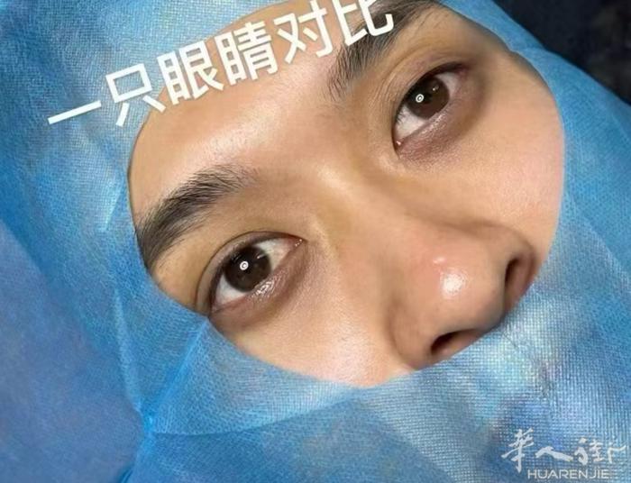 无痕双眼皮