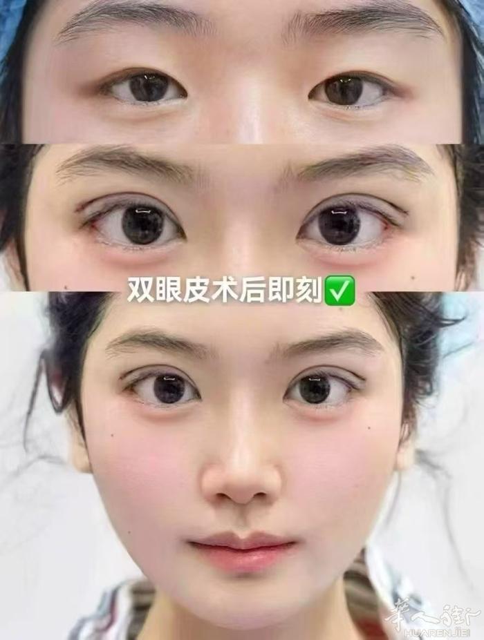 无痕纳米双眼皮，全切双眼皮，各种失败双眼皮。微信：sheyanzhengxing