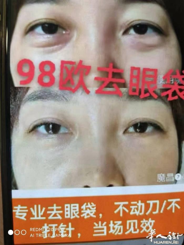活动价（🌹49欧当场去除鼻两侧纹）专业1 8年操作经验《去颈纹，去眼袋》当场见