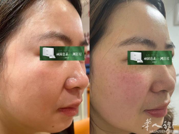 加👇微信，没有套路，追求效果不踩雷 专业13年，治疗各种皮肤问题，各种斑，痘，