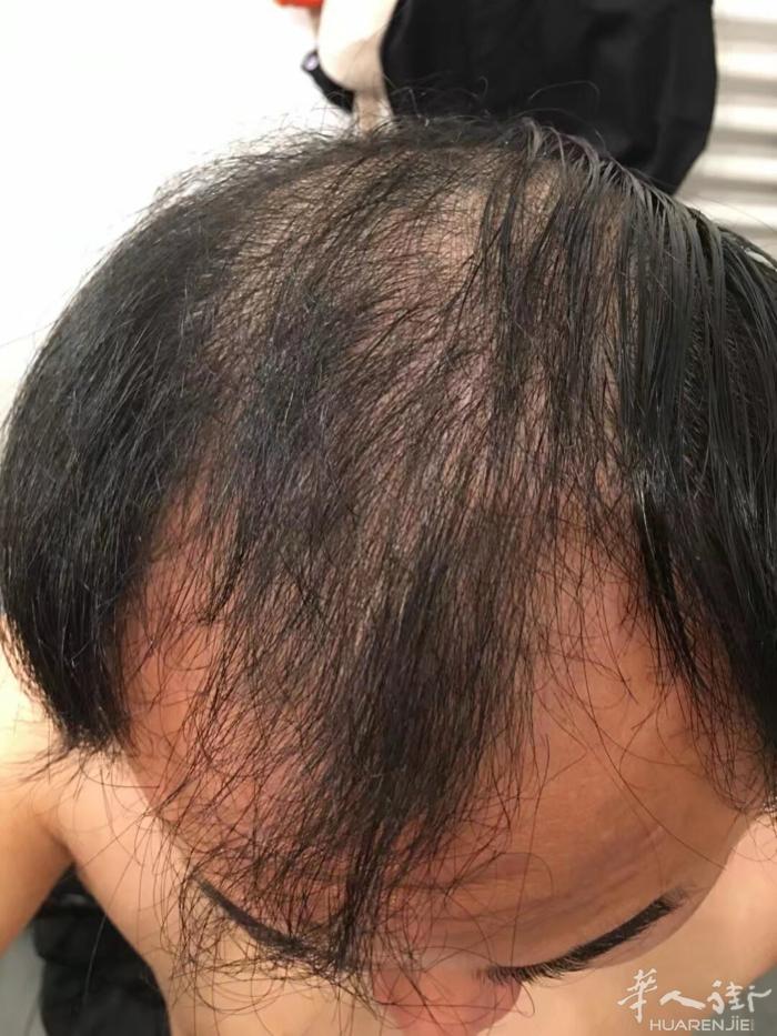 有脱发烦恼的朋友，100天带你上岸，科学养发。亲自体验上岸，所以想帮助有脱发的朋