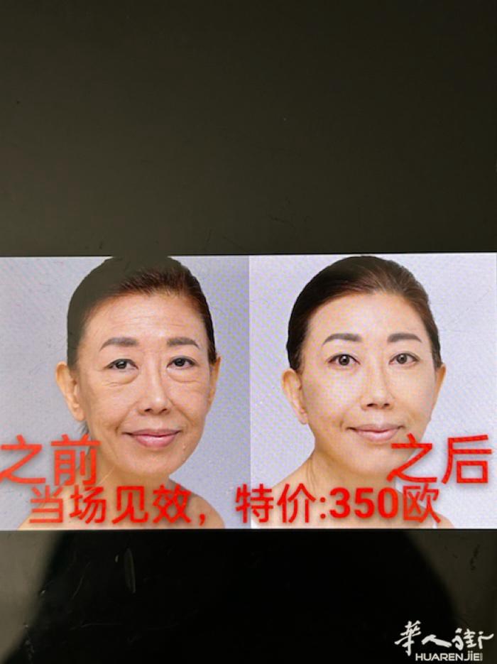 🌳颈部祛皱纹，当场见效，17年操作经验，不打针，不动力，不影响工作，采用美国超