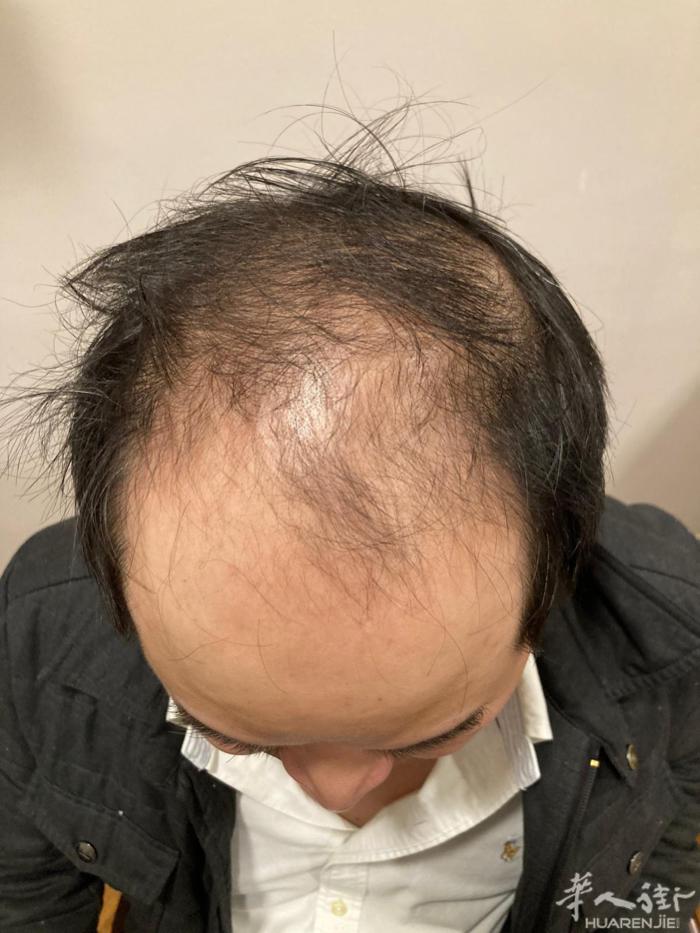 🌱 告别「条形码发型」，90天解锁「浓密BUFF」！意大利王牌植发医生专为华侨