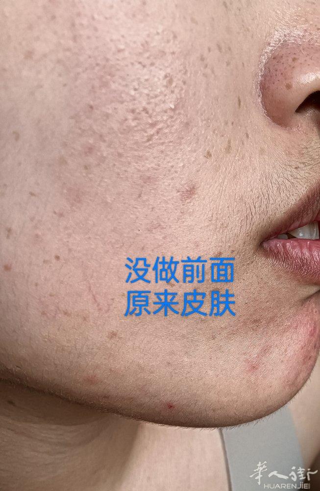 Peeling{韩国微针焕颜}不管你的皮肤有多糟糕，3个疗程让你皮肤重还婴儿状态