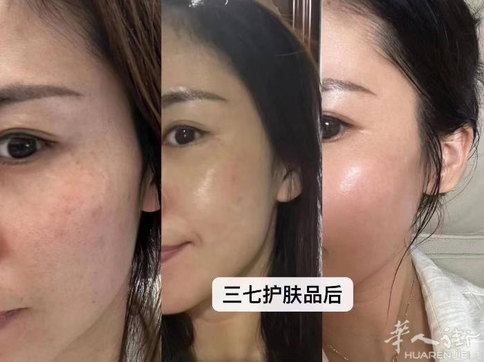 还再医美激光皮秒祛斑吗