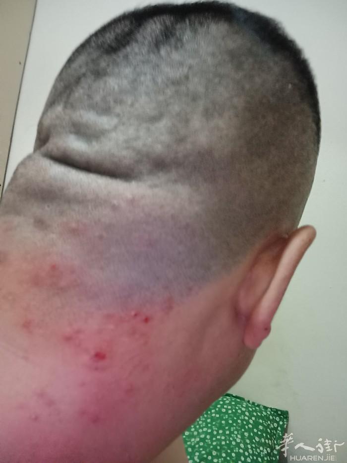 请问普拉托哪里有能看我这个疙瘩的谢谢求医