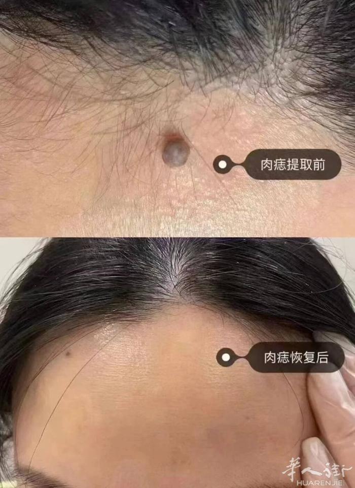 十年经验纹绣 点疣 点痦子 新技术无痛 当场掉 修复期短 可加微信详聊 价格美丽