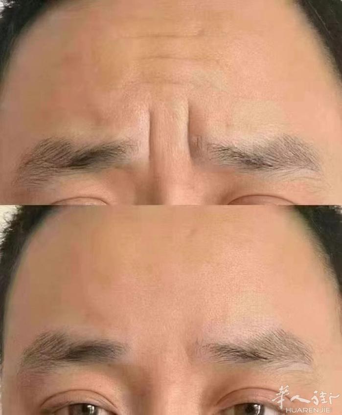 川字纹，眼角纹，针对面部下垂的英伦大提升!