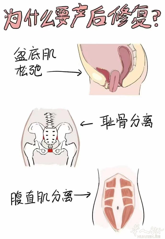 #🌷私密小知识 产后4大隐形杀手，你中了几个？ 1⃣ 盆底肌崩塌——漏尿只是开