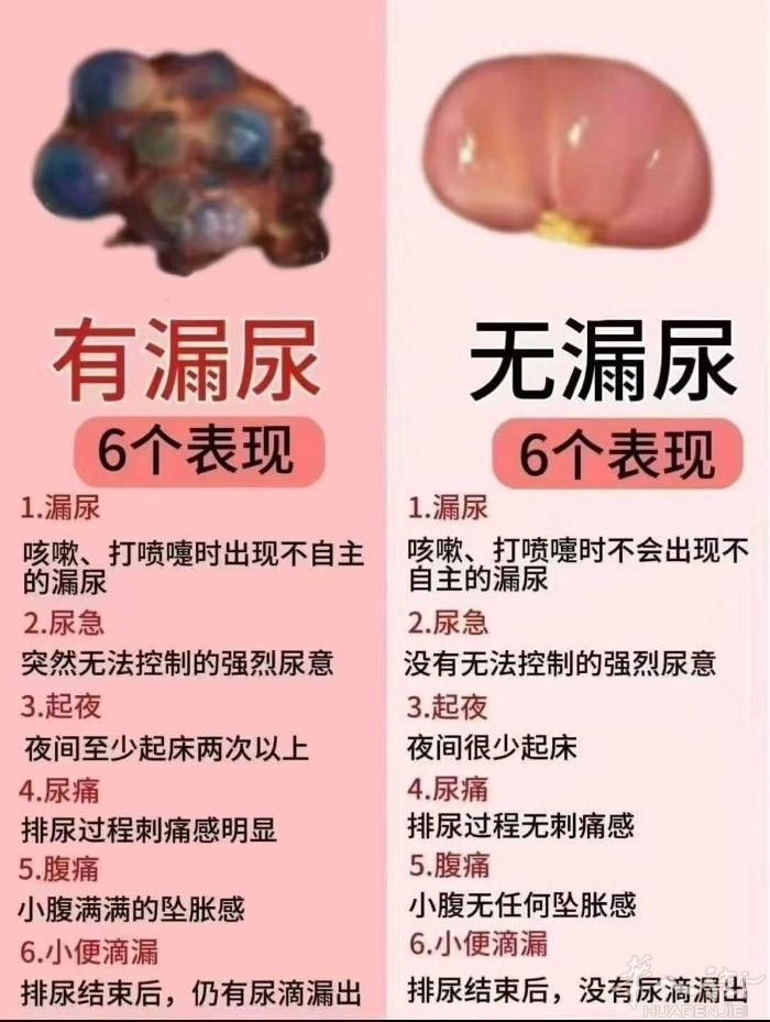 ❤“漏尿” 💦 ，不是老人“专利”，各种年龄段女性都可能遇到，严重影响女性的生