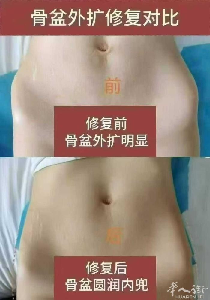 #泰式徒手私密 做完骨盆修复一斤没少 为什么视觉上会瘦🔻🔻🔻 🛎秘密在这