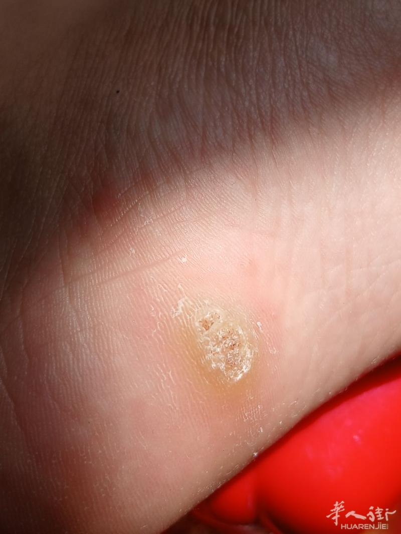 华人街的街友们，有看疣的皮肤科医生介绍吗？？？小盆友脚底长了个疣，抖音说是路疣，免疫力低，病菌引起的！