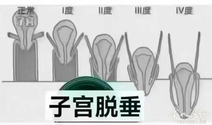 有一天发现， 子宫"突然"掉出来了 😱 30岁不在意 🙄 40岁没精力 😫