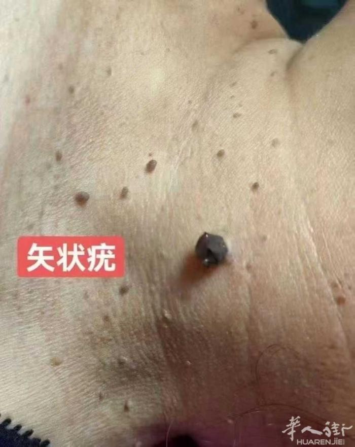 专业无痛不留疤，祛疣，点痣。刮痧拔罐，头疗。有需要的朋友请加微信了解。wenmi