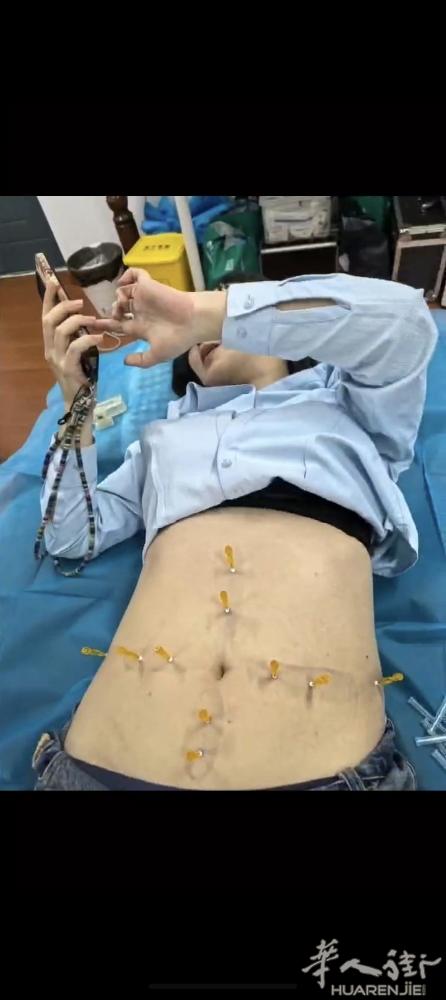 从中医角度看，疾病的发生主要是由于 “经络不通” 或 “气血失调” 。针灸的治疗