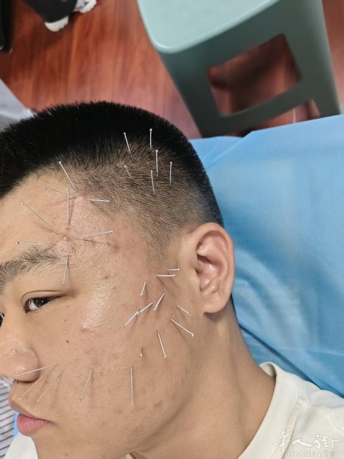 面部针灸美容 调理气血 脸色有好转 直接打电话 微信liaoa666liaoa