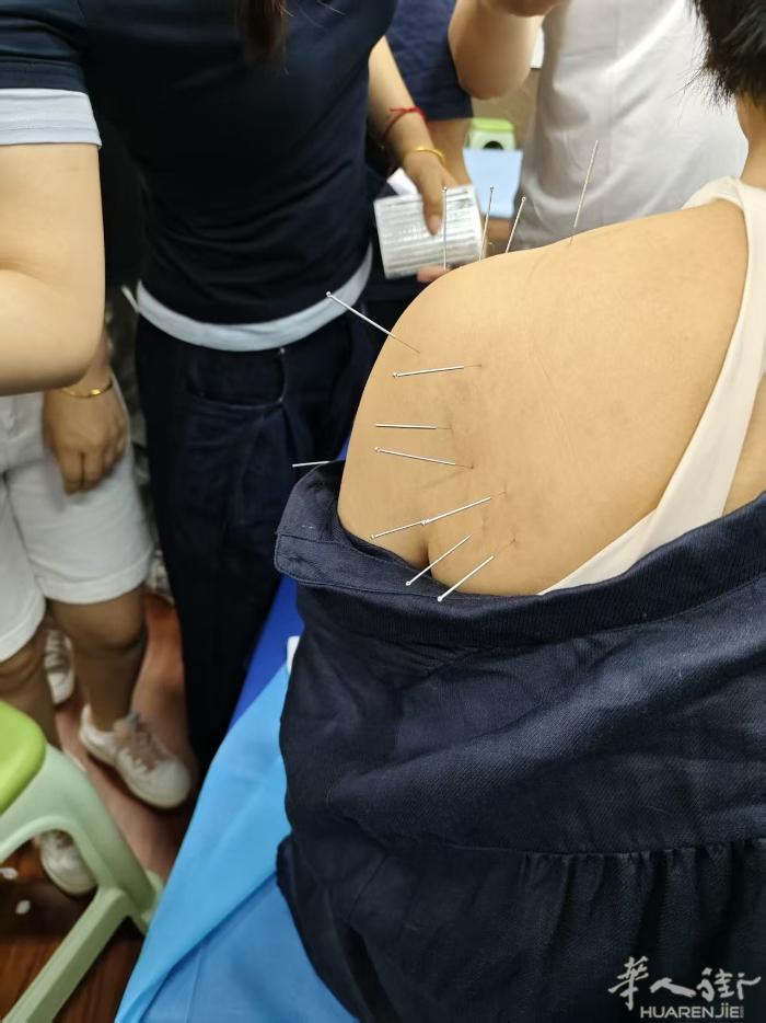 肩周炎· 原理：针灸可以刺激神经系统，促使身体释放内源性的镇痛物质，如内啡肽、脑