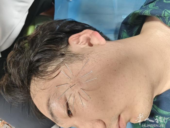 针灸围刺治疗黄褐斑 疏通局部血液循环 VX  :liaoa666liaoa