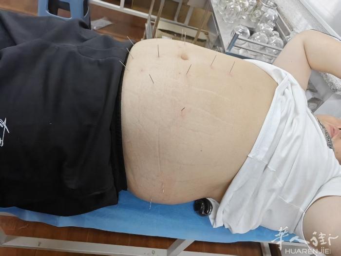 针灸二次调理 VX liaoa666liaoa