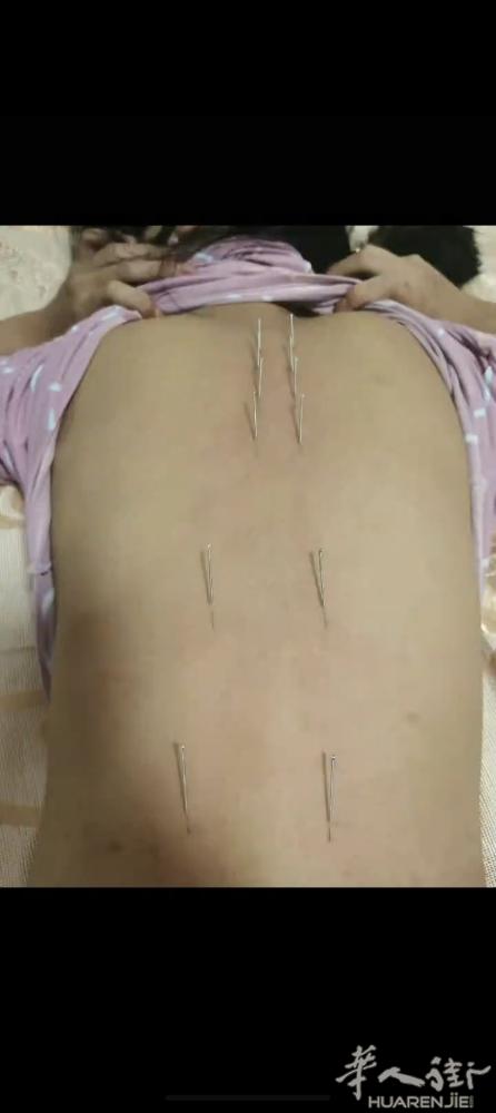 针灸荨麻疹见效VX： liaoa666liaoa