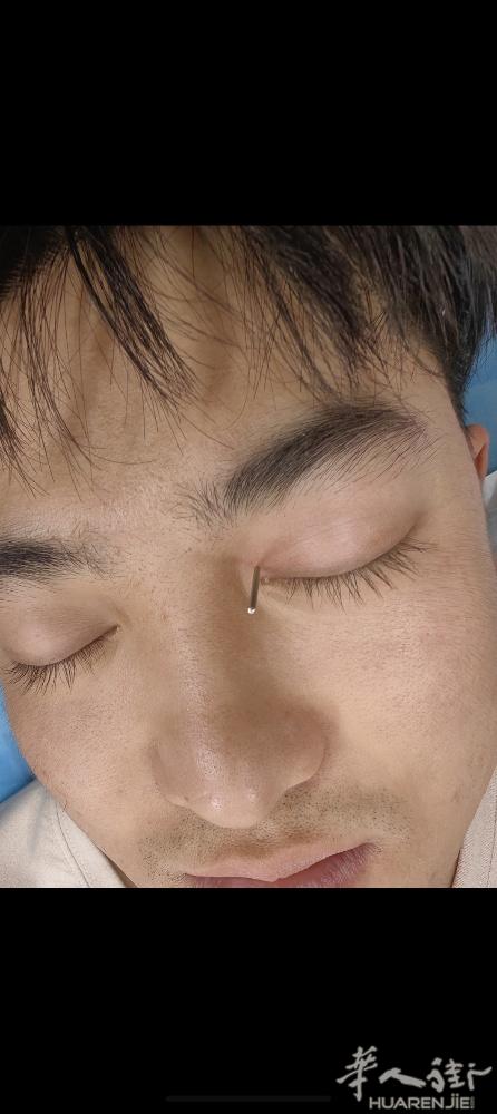 针灸治疗眼疾