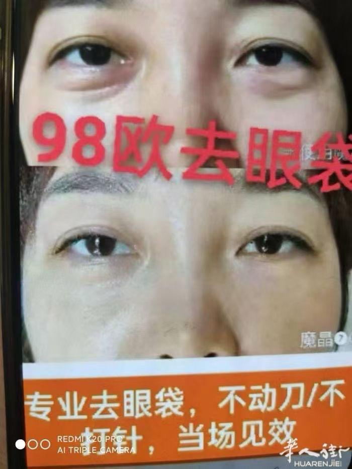 （特价月五折）今天给顾客操作脸部祛皱纹， 做之前拍照，先做一侧脸