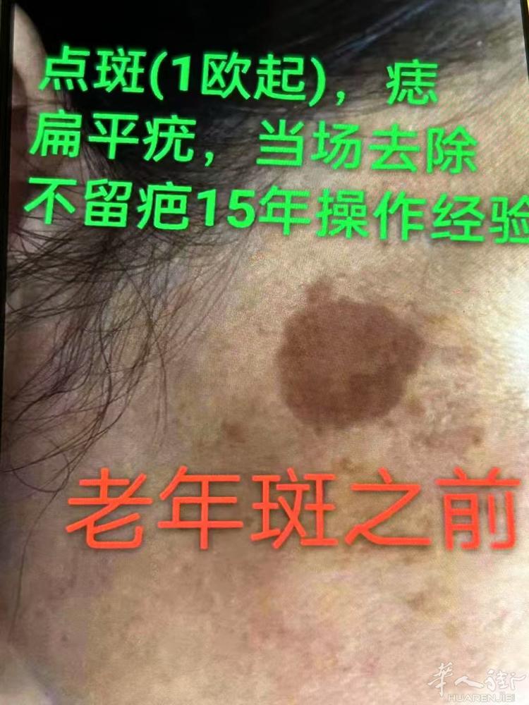 18年专注皮肤管理，老年斑扁平疣当场去除，不留疤痕，一次性操作当场去除 从色