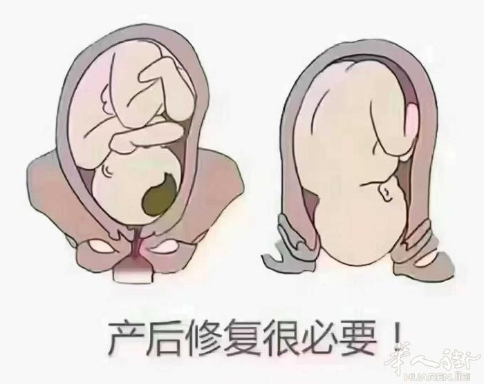 告诉你为什么会松？看图片👇 如果你拼了命的把孩子生下来 产后出现：腰痛、漏尿、