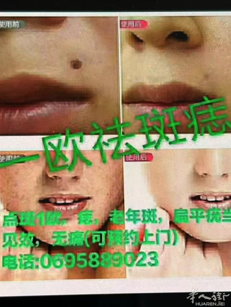 迎圣诞，1欧起去除小斑点，当场见效，不病疼，不反弹，不影响工作，不留疤，让自