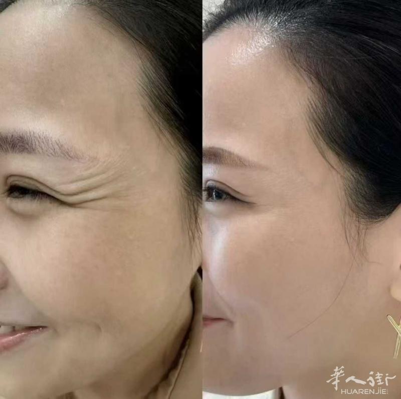 专业美容医美18年，擅长减肥、水光、除皱，瘦脸、玻