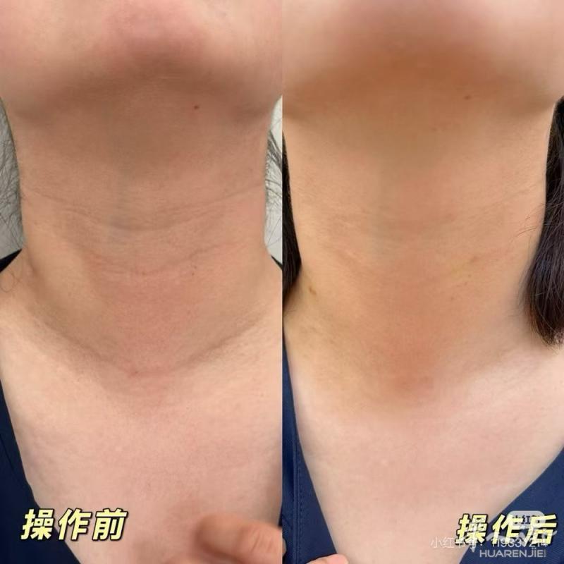 🍏花一次费/给办年卡/颈部及全脸/预约随时操作，去皱纹当场见效，无效不收费，1