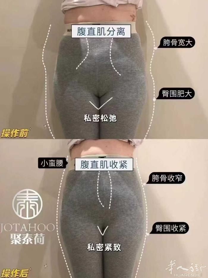 产后骨盆恢复到底是不是智商税？ 骨盆调整当场立即对比🆚 并且效果不会反弹 骨盆