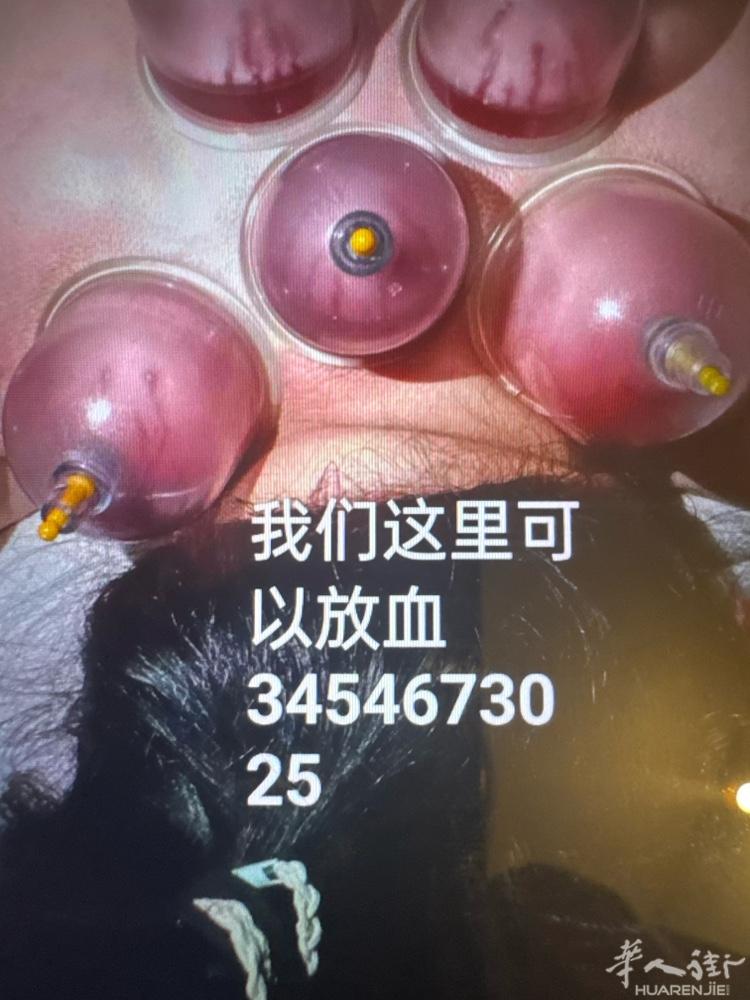 Prato中国街附近正规推拿30一个小时，有艾灸，艾草泡澡，采耳，放血…….需要