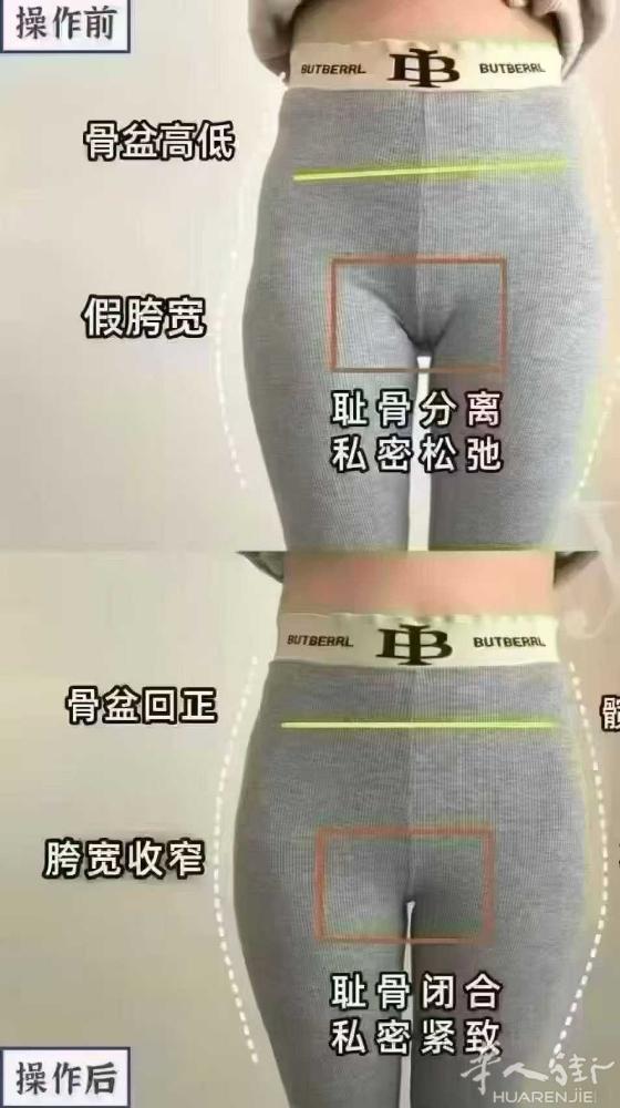 ❤千人千骨盆 一人一症一方案 ✅胯骨闭合，当场收2到8公分[胜利] ✅无论产后5
