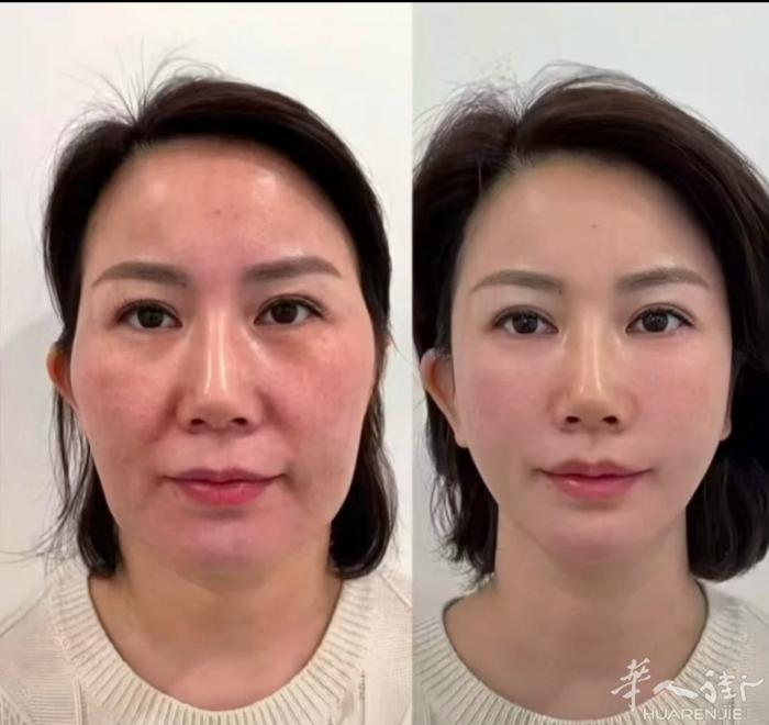 中式面部骨雕 捏脸徒手 捏出年轻紧致轮廓   想改善面部松弛、法令纹、大