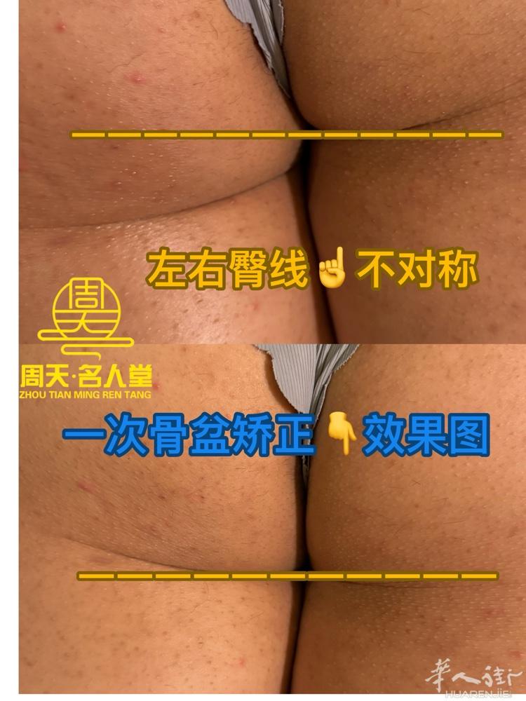 骨盆不正脊柱侧弯引起的腰痛：  脊柱侧弯让腰方肌代偿，导致它过度工作并出现疼痛，