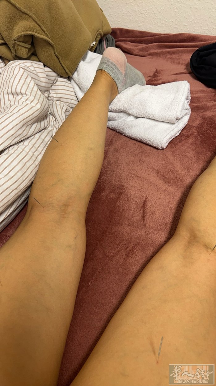 上门针灸推拿按摩，有意的朋友加微了解1013452878