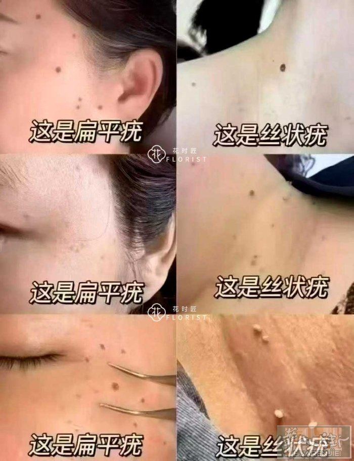 疣”不分公母，每一颗都具有传染性!一不留神就会复制到全身 疣是人类乳头瘤病毒，正