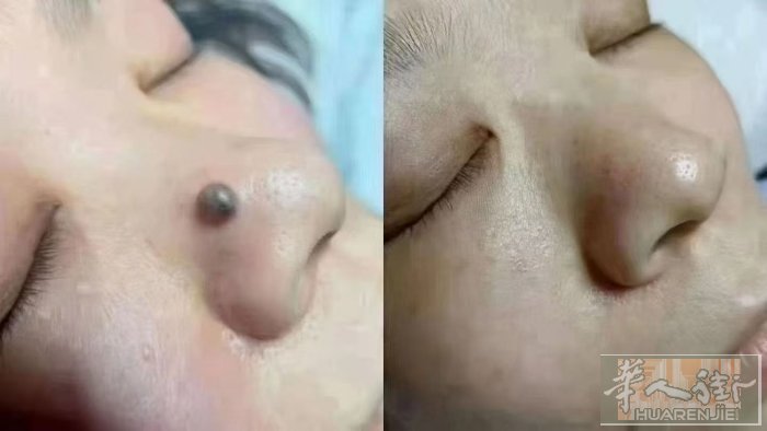 点痣疣瘊，有需要可以联系我