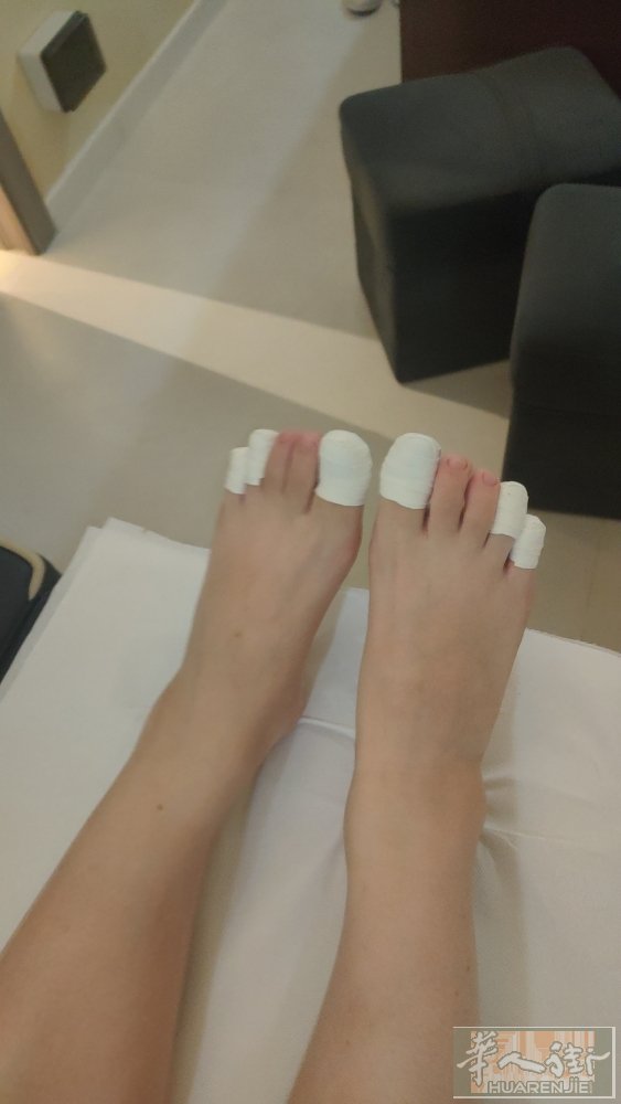 专业修脚师，灰指甲根除长出好指甲。嵌甲甲沟炎矫正彻底除根不在长肉里。鸡眼肉刺跖疣