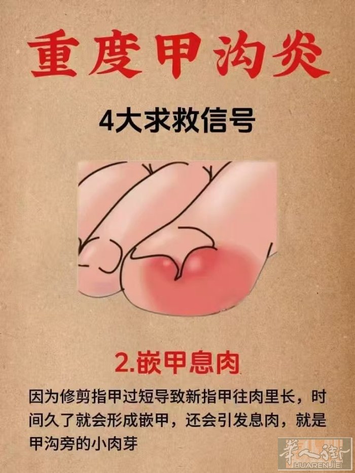🍀灰指甲 中国刚出来的最新升级技师 服务项目：普拉托首家最专业康复灰指甲 专业