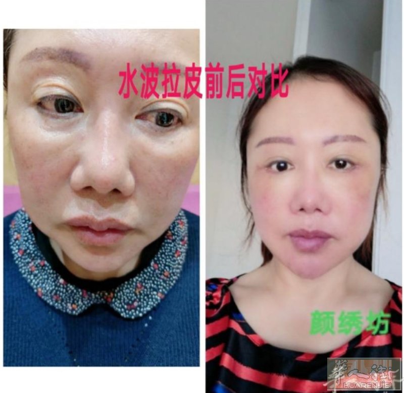 最新的韩国技术带给爱美的人士！水波拉皮：一次拉皮立马可以年轻十岁，可以维持一辈子