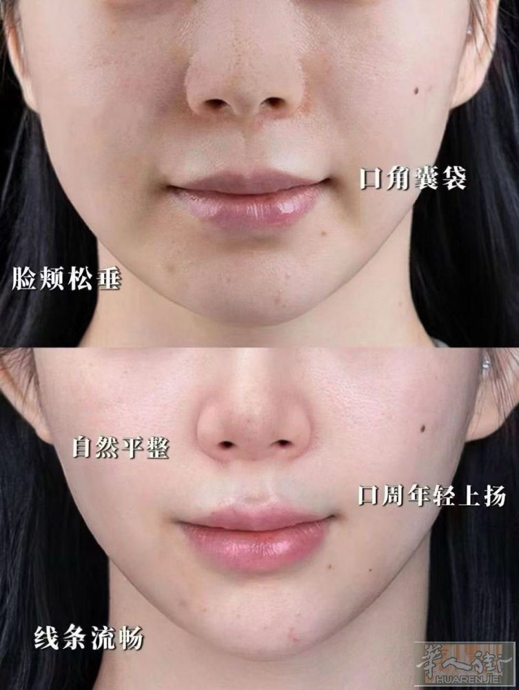 马德里可约面部水光，眼周水光，颈部水光，祛皱（抬头纹，眼角纹，川字纹，鼻横纹等）